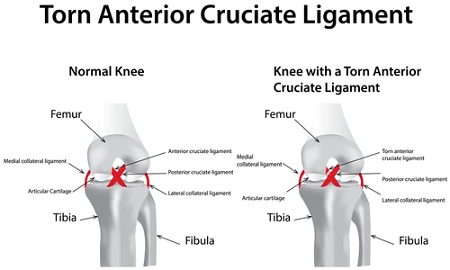 A preview image for the article: Neuromuscular Training Program Can Reduce ACL Injuries In Athletes By 63%