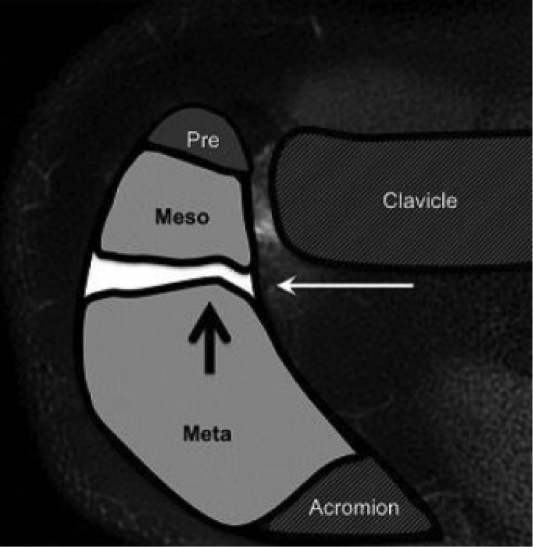 Acromial apophyses