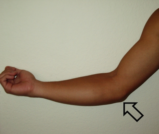 photo of someone's arm with an arrow pointing to the elbow